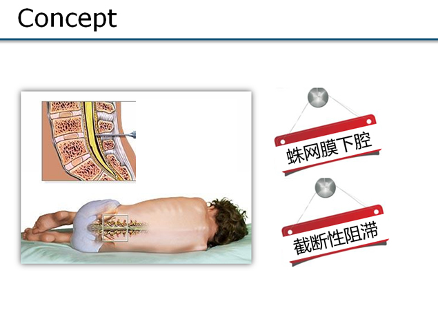 蛛网膜下腔阻滞